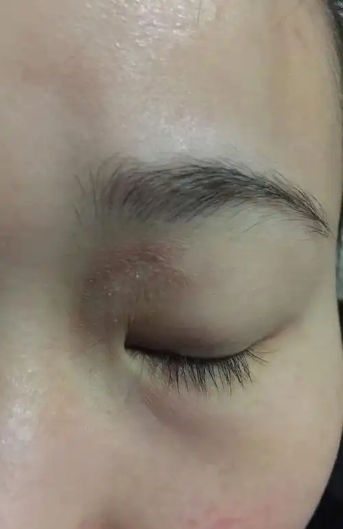 我是神经性皮炎吗?