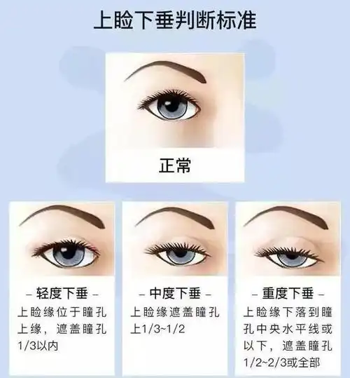 患者公益慈善活动|手术|弱视|治疗|眼睑下垂|世界男性健康日_网易订阅