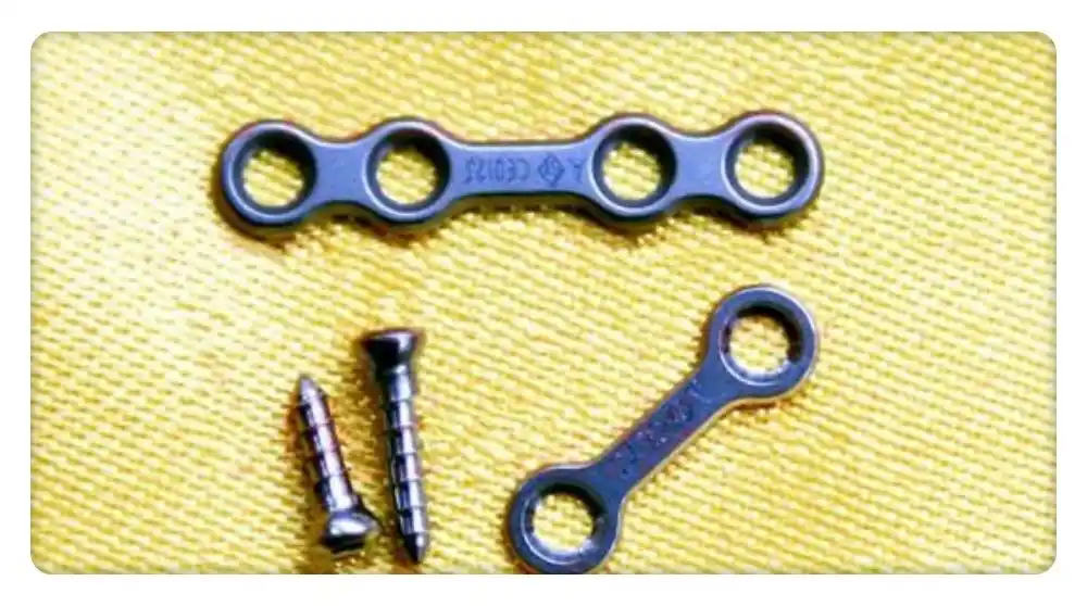 正颌手术用钛板钛钉固定安全吗?