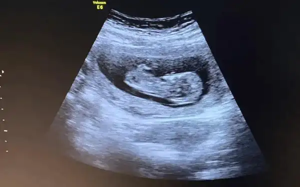 nt图像上有三个点是怀女孩的概率更高吗?