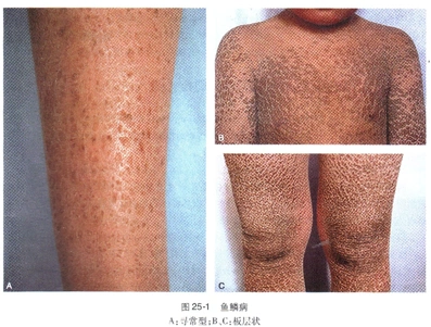 鱼鳞病的临床表现