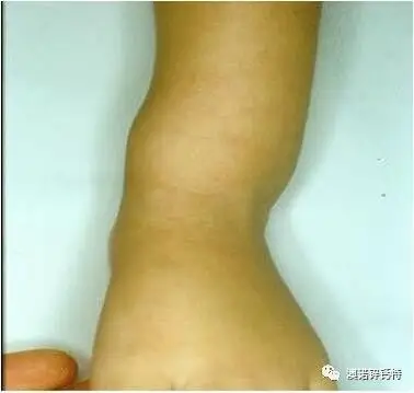 小儿佝偻病补维生素d和钙就够了吗