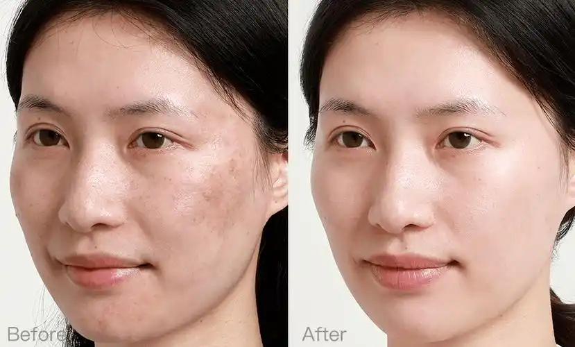 祛斑_闪斑_基因