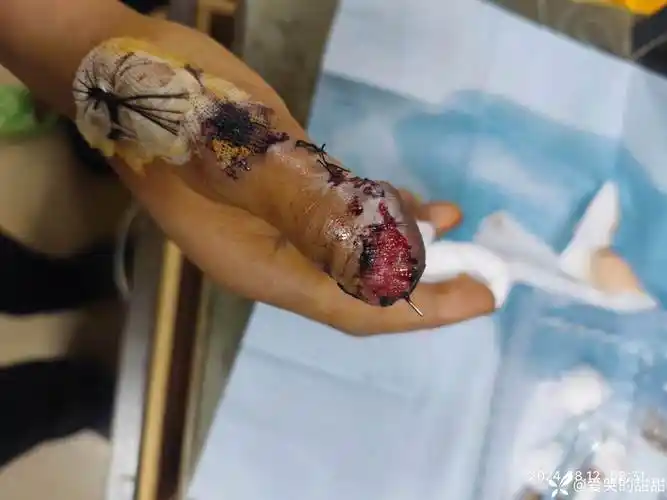 拇指末节皮肤坏死