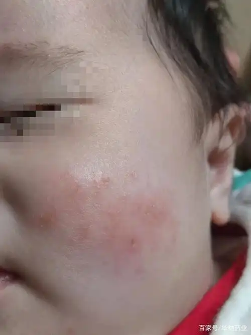 4个月宝宝脸部干性湿疹应该如何处理?