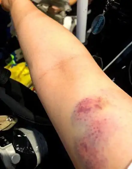 韩国超人气男团机场出行,粉丝却遭保安殴打,伤口令人触目惊心