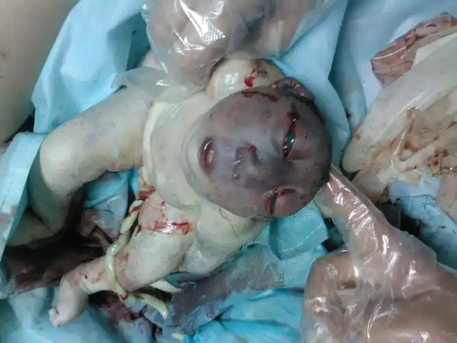 胎儿无脑畸形及脊柱裂罕见