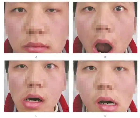 斯的明试验除外重症肌无力;可卡因和肾上腺素实验除外交感性神经下垂