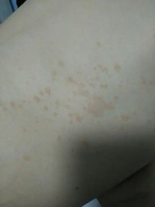 肚子上起了快斑