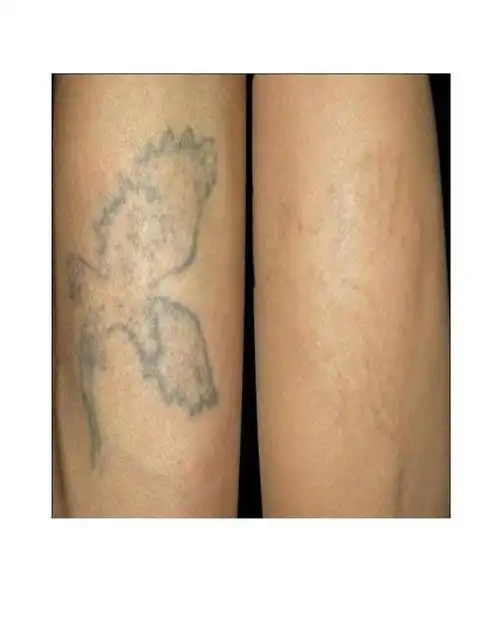 激光洗纹身疼不疼?