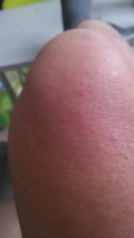 膝盖上起了许多小红点,不挠好点,越挠越痒,皮肤发热,请问是什么皮肤病