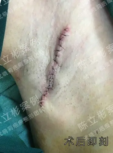 腋下增生性疤痕术后25个月复诊