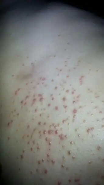 胸口长了很多红疙瘩半个多月了,开始不痒近一个星期很痒.