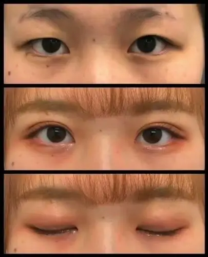 双眼皮投稿:日式无痕埋线双眼皮 7毫米. 来自象腿叔叔 - 微博