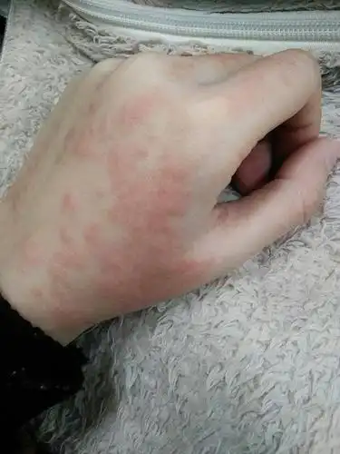手背上很痒 而且有很多红肿的块~手心也有很多小水泡