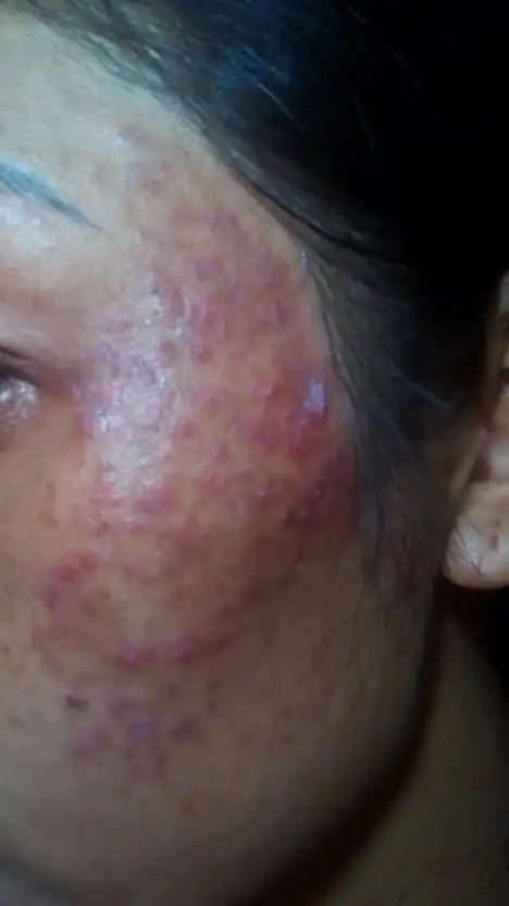 谁能告诉我脸上出现这是什么皮肤病呀