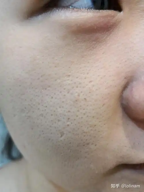 毛孔粗大用洗面奶有用吗