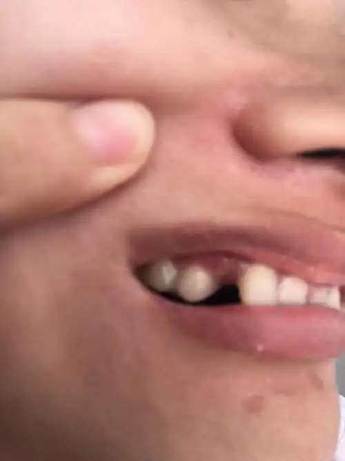 5 小时候的乳牙没有掉前年断掉了只剩牙桩,昨天去拔掉了打算镶一颗