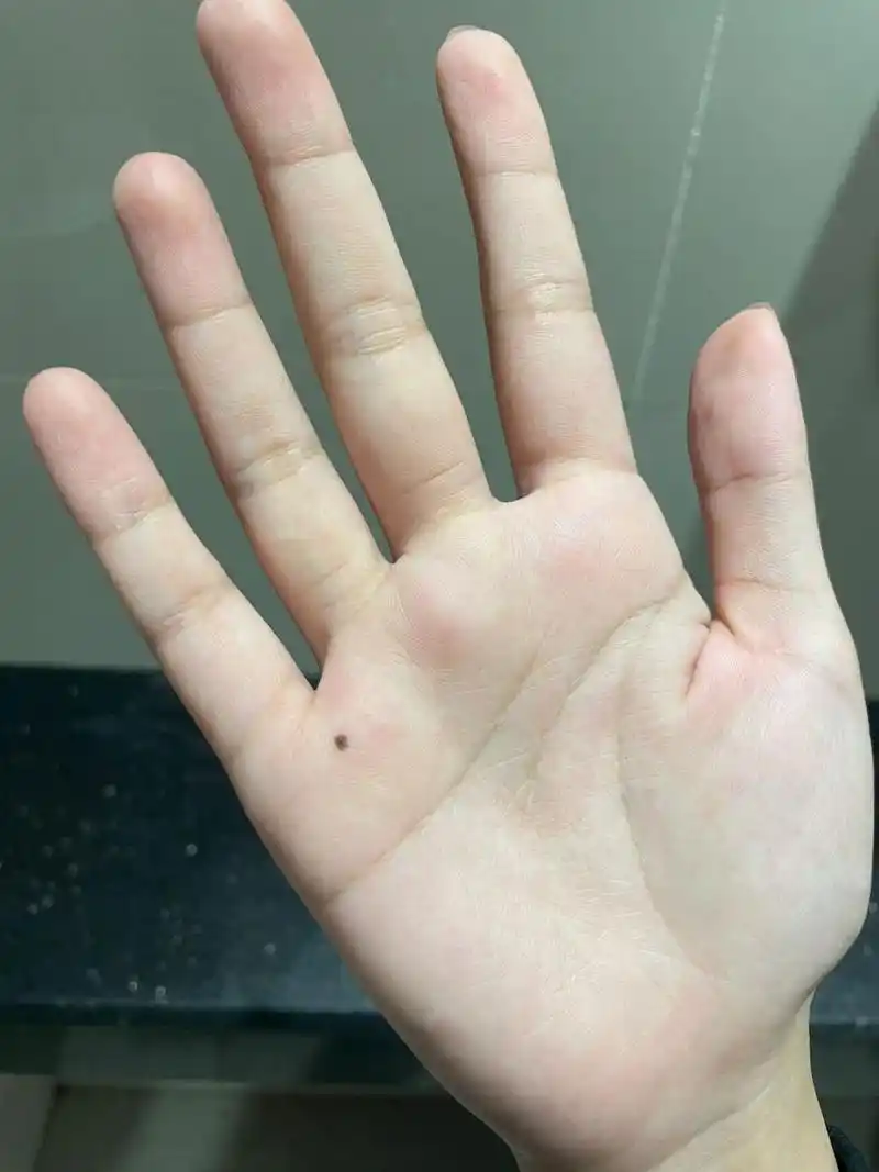 手心长痣 不知道什时候突然右手掌长了一颗大痣,这代表着什么04