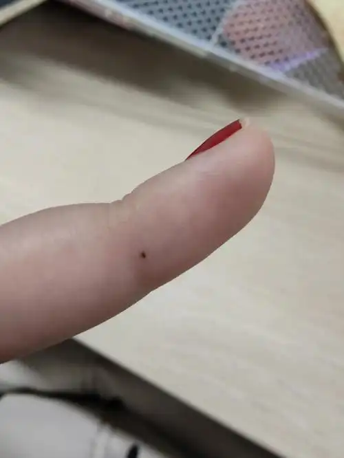 21年12月份发现左手的中指上长了个小痣,在侧边,经常和食指摩擦,我在