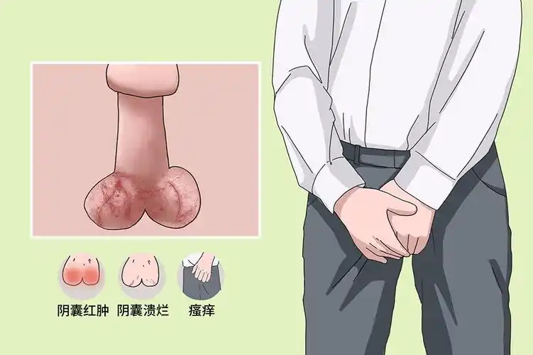 阴囊湿疹