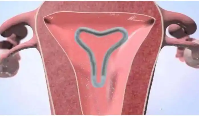 放置宫内节育器和鞋子穿在脚上的感觉是同样一个道理