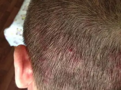 毛囊炎的症状及照片,毛囊炎怎么治,能治好吗?_治疗_头皮_药物