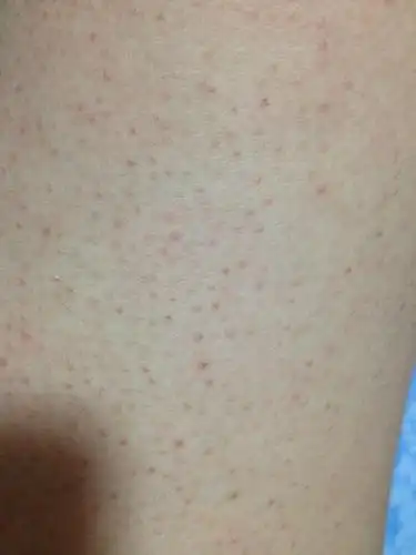 皮肤上的红点是什么