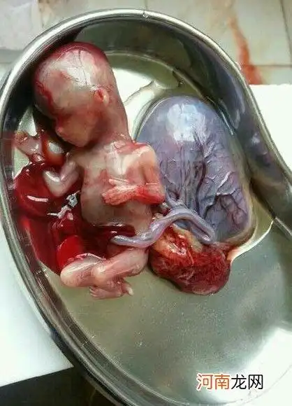 怀孕四个月了,还能打胎吗