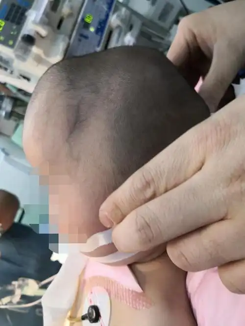 1岁多的星星(化名)自从生后头型就和普通宝宝不一样,高耸凸出的前额