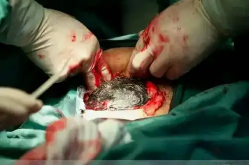 100张照片,100%还原"剖腹产"全过程!(有图慎入)
