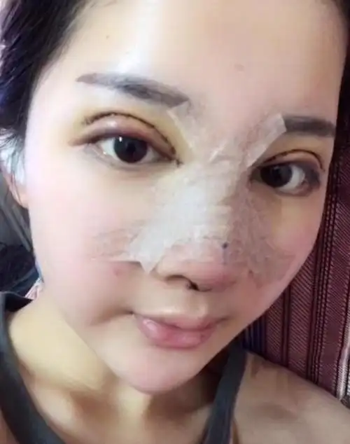 18岁美女花百万整容千辛万苦高仿热巴恢复后秒杀原版