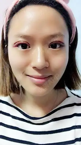 定点双眼皮术后第三天.