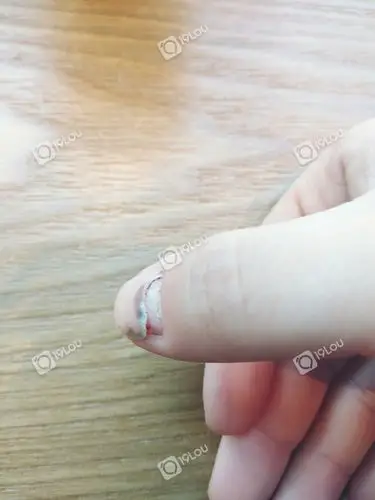整个指甲盖像脱壳一样的好吓人