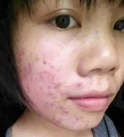 脸上长痘毒素多 皮肤排毒有妙招