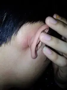 耳前淋巴结肿大的症状,耳前淋巴结肿大怎么办,耳前淋巴结肿大护理