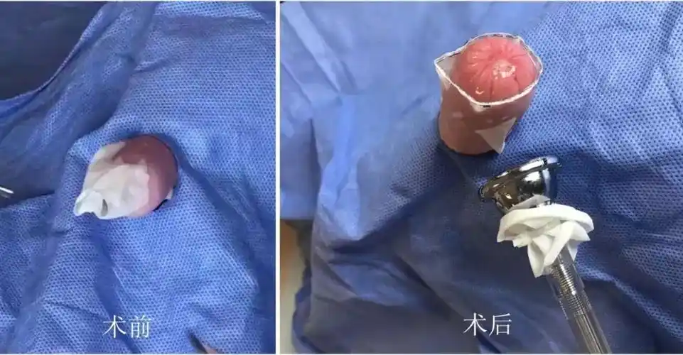 缺点:费用高,约是环切器手术的3倍,恢复期约2周,钉子掉的过程也会有