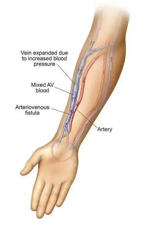 在我们的身体上有各种各样的动脉,有一些动脉可能会消失,有一些动脉