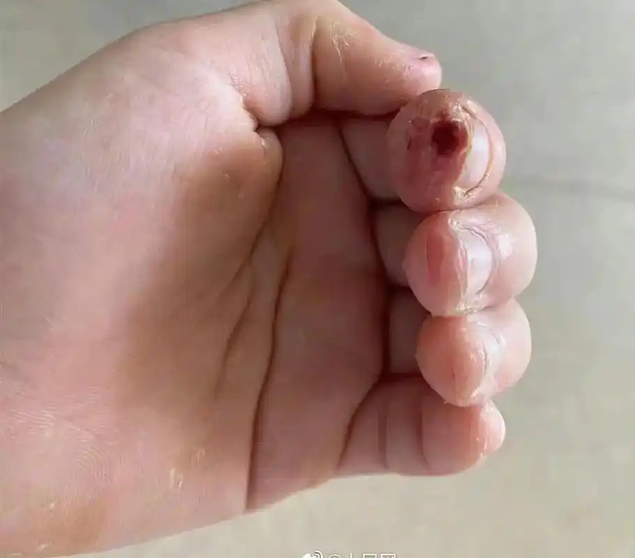 九岁女孩长期啃指甲致指骨如虫蛀一般.