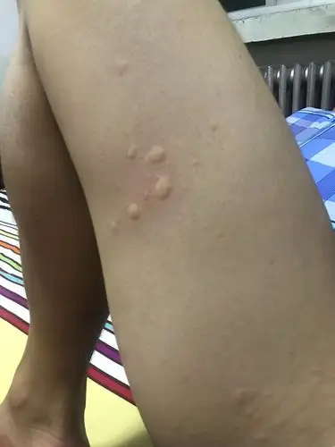 不知道怎么突然起来像蚊子咬下似的包,一片一片的,但是睡醒之后就没事