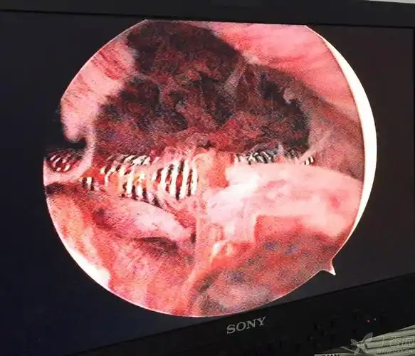 节育环在宫腔形态