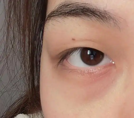 眼睛下面眼袋附近突然长红肿块