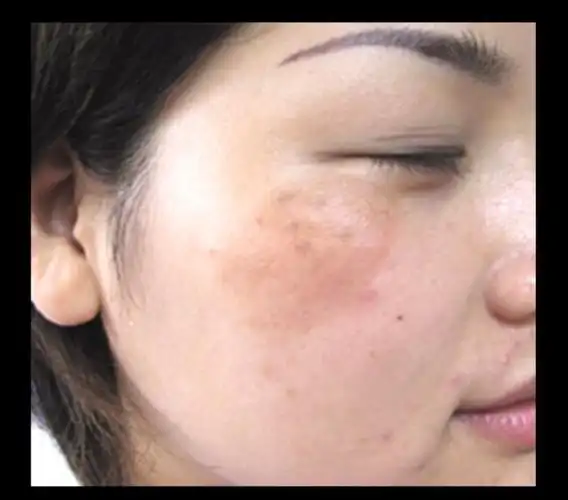 你还能说自己.不知道肝斑是什么了吗?