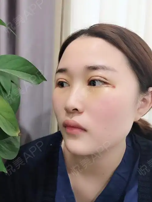 全切双眼皮术后3天_眼综合术后3天_开眼角术后3天_双眼皮术后3天_眼部