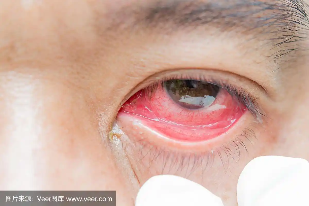 红血丝眼睛