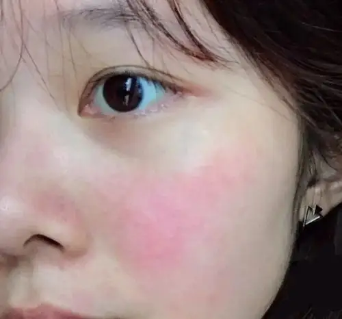 皮肤有颗"玻璃心",又痒又红很任性!怎么办?-李远宏主任医师-爱问医生