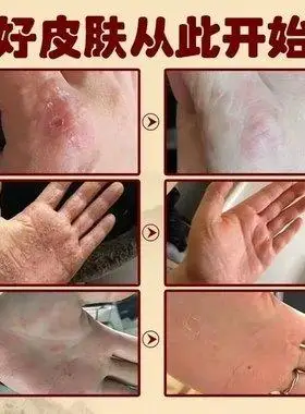 专治鹅掌风手癣真菌感染干裂水泡手足藓汗疱湿疹脱皮止痒去根药膏
