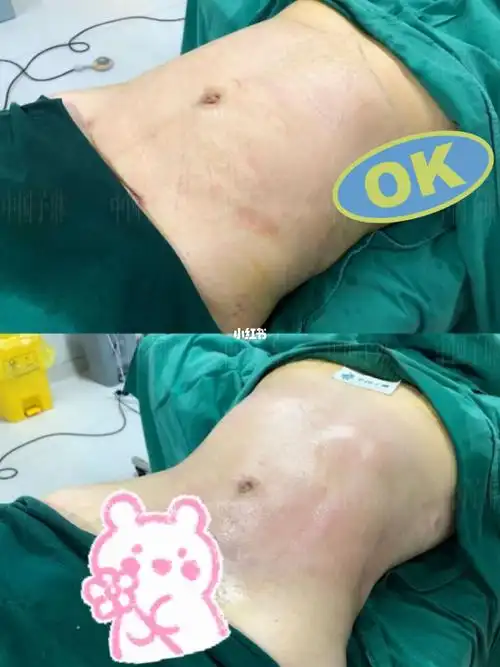 威塑腰腹环吸,术后即刻反c腰线_腰腹_环吸_减肥_减肥医药