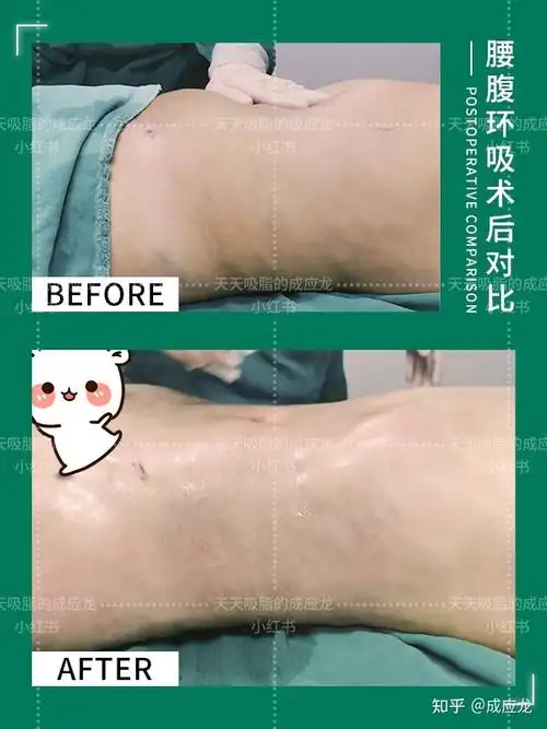 大多数求美者在做吸脂手术之前都会问一个共同的问题"吸脂后皮肤会