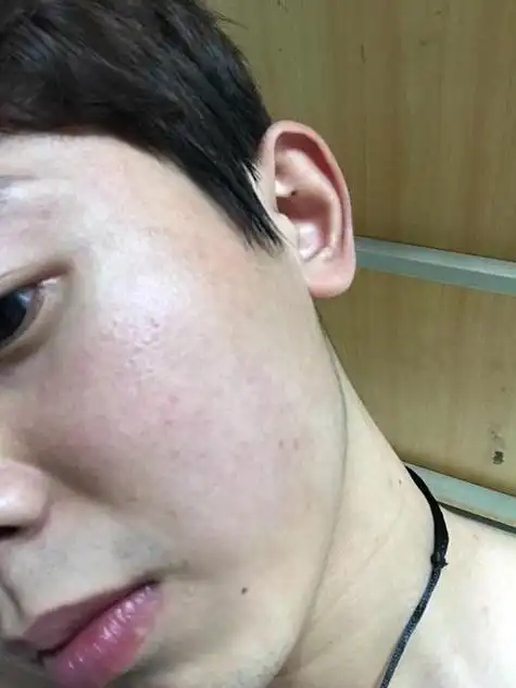 脸用化妆品过敏红肿痒怎么办化妆品过敏眼睛红肿痒怎么办